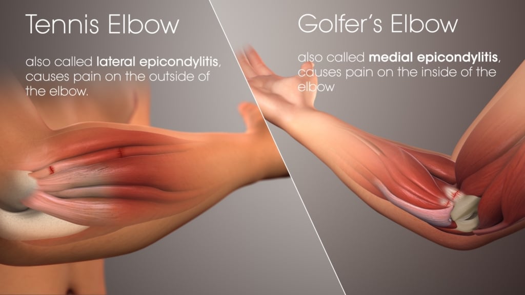 Can Golf Cause Tennis Elbow 
