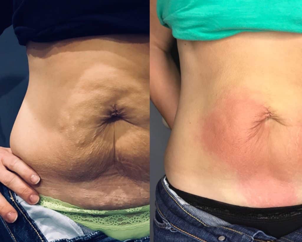 Abdominal-skin-tightening-without-text-1024x821