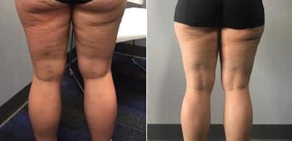 Cellulite-one-treatment