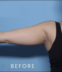 Before Arm Sculpt