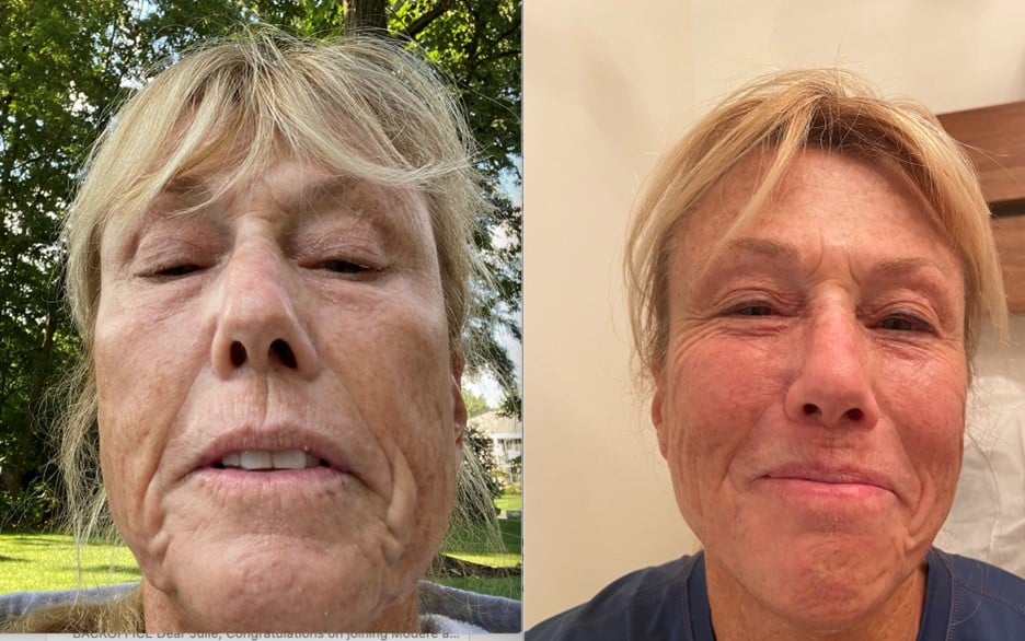 Bioptron Light Therapy Before And After Treatment Photo