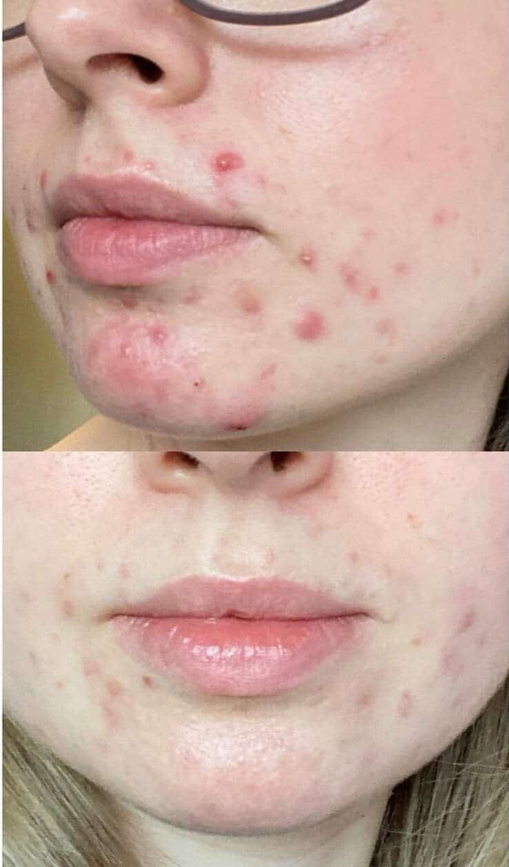 Before And After Photo Of Acne Treatment