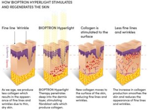 How Bioptron Hyperlight Stimulates And Regenerates The Skin