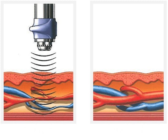 Shockwave Therapy for ED Before-After